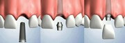 Обязательные этапы имплантации зубов