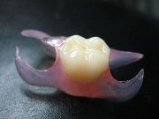 В каких случаях устанавливают временный зубной протез бабочка
