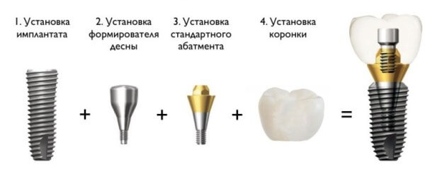 Этапы установки имплантата
