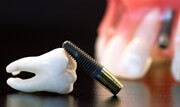 Сколько стоит вставить надежный имплант зуба