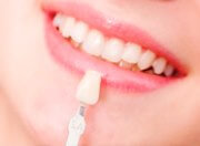 Плюсы и минусы прямых композитных виниров