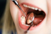 Порядок лечения кариеса молочных зубов