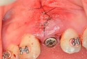 Насколько вероятны осложнения после имплантации зубов