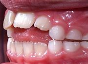 Как диагностировать открытый прикус зубов