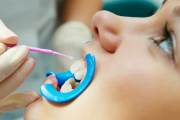 Плюсы и минусы покрытия зубов лаком