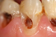 Особенности развития пришеечного кариеса передних зубов