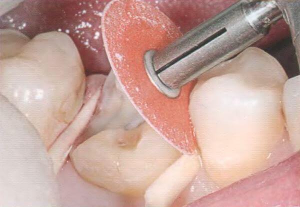 Способы проведения шлифовки зубов