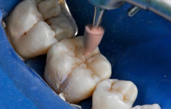 Как влияние шлифовка на зубную эмаль