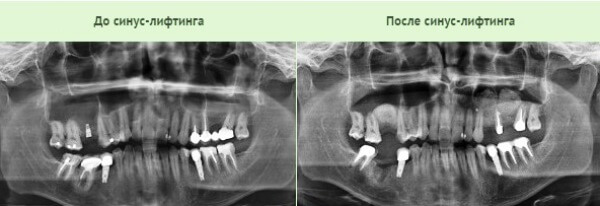 методика синуслифтинг в стоматологии - что это такое