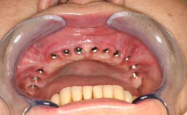 Требования к состоянию тканей для установки имплантов зубов