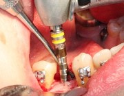 Сколько примерно стоит поставить имплантант зуба