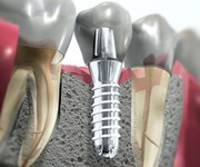Сколько стоит установка имплантата зуба