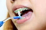 Советы по уходу за зубами с брекетами