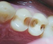 Почему выпадают пломбы из только что запломбированных зубов