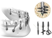 Плюсы и минусы метода базальной имплантации зубов