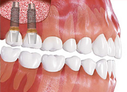 Обязательные этапы имплантации зубов с наращиванием костной ткани