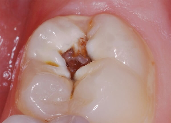 Особенности наложения чеснока на зуб