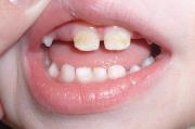 Как распознать гипоплазию эмали зубов у детей