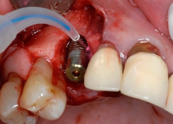 Ход процедуры лазерной имплантации зубов