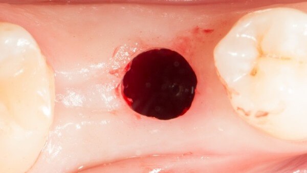Плюсы и минусы лазерной имплантации зубов