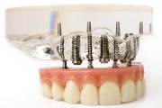 Сколько в среднем стоит вставить имплант зуба