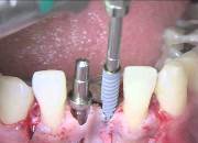 Сколько стоит установка имплантанта зуба под ключ
