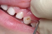Способы лечения поверхностного кариеса молочных зубов