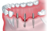 Что влияет на цену базальной имплантации зубов 