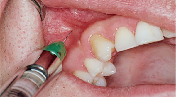 инфильтрационная анестезия в стоматологии показания