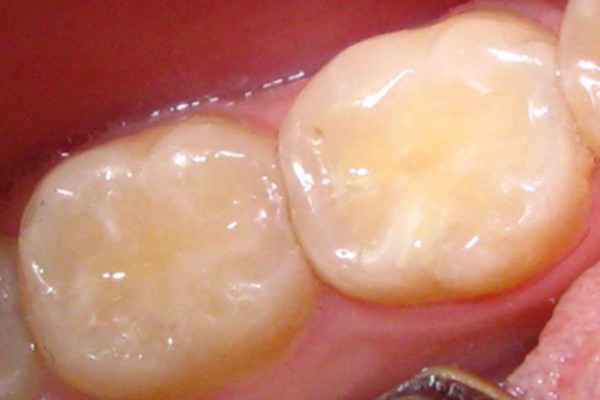 сколько стоит поставить пломбу на передний зуб