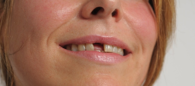 протезирование одного зуба без обточки соседних зубов