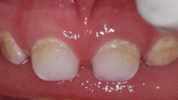 классификация некариозных поражений зубов по патрикееву и мкб 10