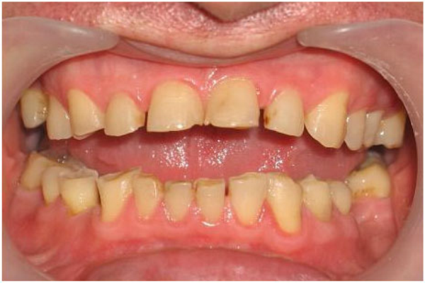 профилактика некариозных поражений твердых тканей зубов
