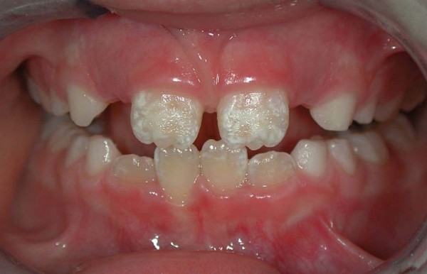 лечебная концепция реставрации зубов при некариозных поражениях