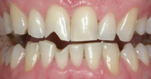 факторы риска некариозных поражений зубов