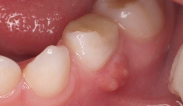 после лечения зуба белая шишка на десне