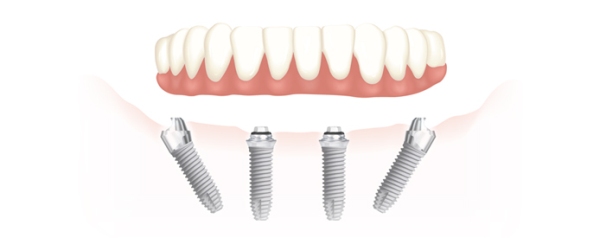 Имплантация зубов all on 4