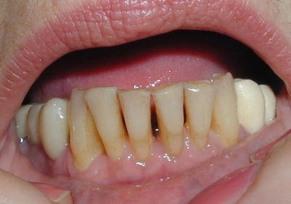 Ломит зубы причины чем лечить