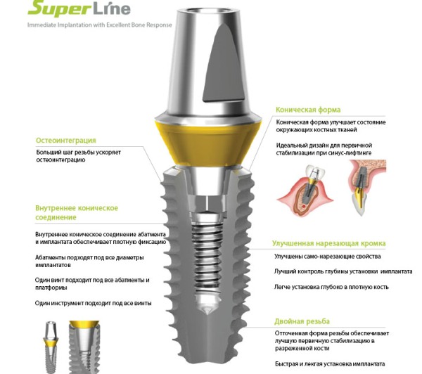 Superline импланты срок службы