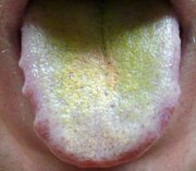 Причины и лечение зеленого налета на языке