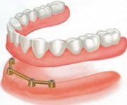 Конструкция балочного протеза на имплантах