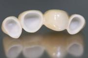 Сколько стоит керамическая коронка на зуб
