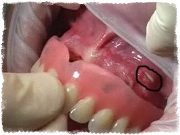 Почему натирает зубной протез