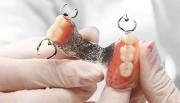 Протез зубов натирает десну