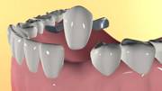 системы протезирования зубов без обточки