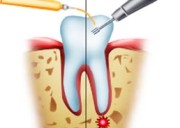 Что такое гемисекция зуба