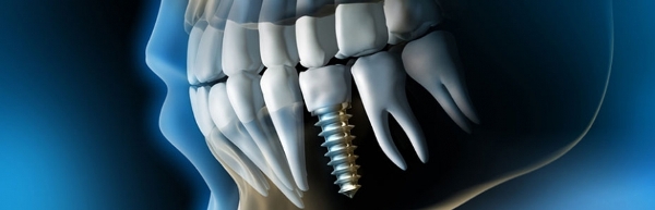 Имплантация зубов недорого цены