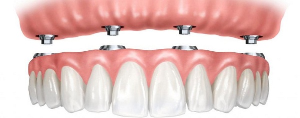Имплантация зубов недорого как экономить