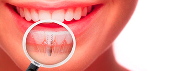 Имплантация зубов недорого способы сэкономить