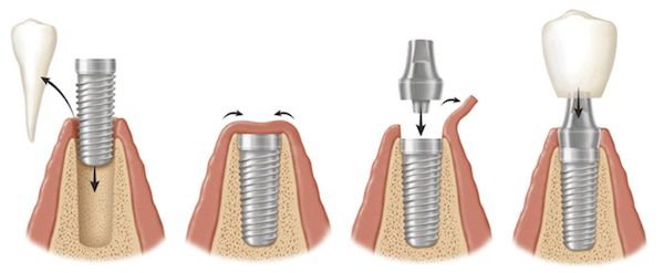 Порядок проведения двухэтапной имплантации зубов